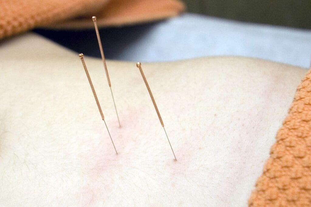 Moxibustion bzw. Moxa-Therapie